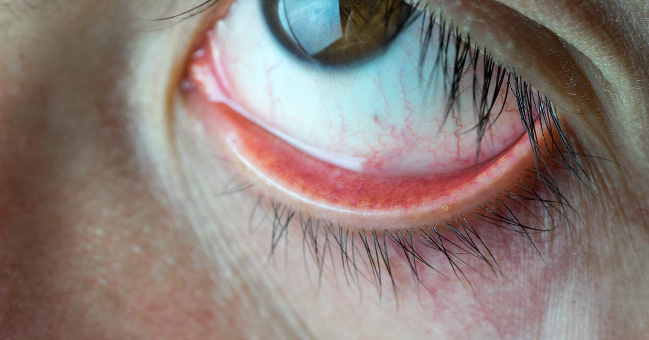 Titelbild: Fremdkörpergefühl im Auge? Ursache und Lösung bei trockenen Augen mit Lidhygiene